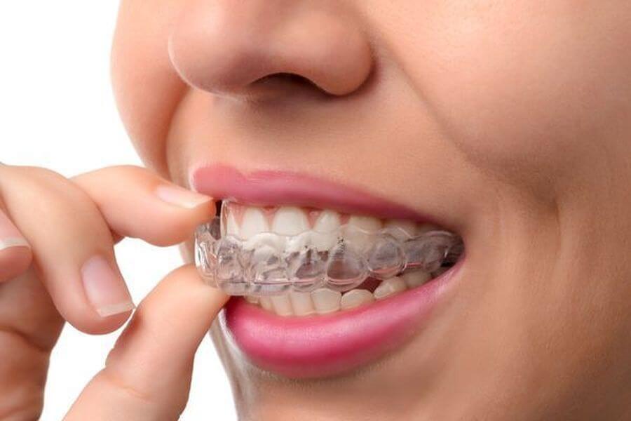 Arquivos aparelho dental - VS Ortodontia