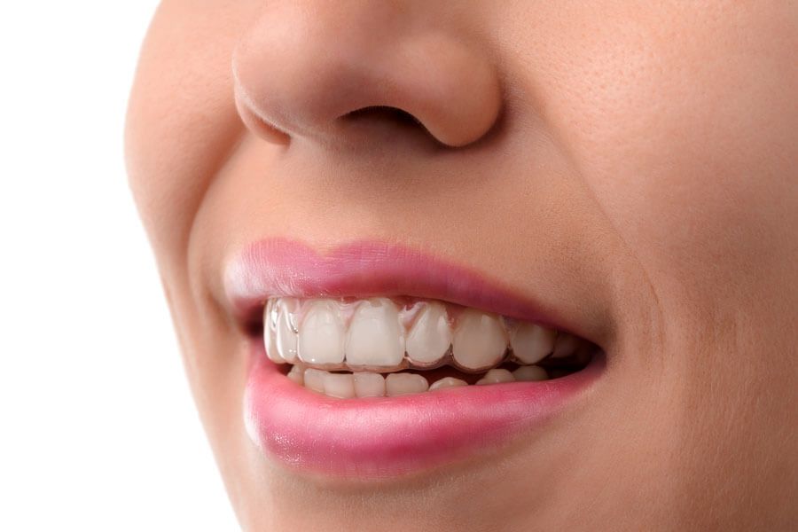 Invisalign  ortodontia
